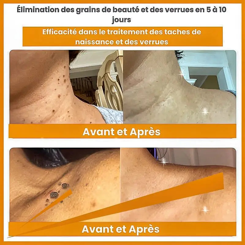 Éliminez Vos Imperfections de Peau en 5 Jours - Spray au Venin d'Abeille, Naturel et Efficace, Testé Dermatologiquement