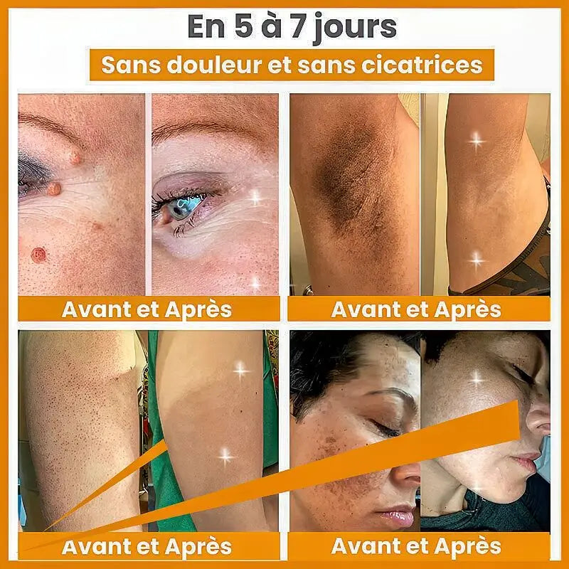 Éliminez Vos Imperfections de Peau en 5 Jours - Spray au Venin d'Abeille, Naturel et Efficace, Testé Dermatologiquement