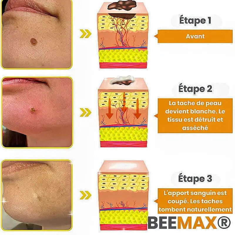 Éliminez Vos Imperfections de Peau en 5 Jours - Spray au Venin d'Abeille, Naturel et Efficace, Testé Dermatologiquement