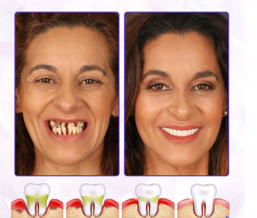 Dentifrice avancé pour la guérison des gencives
