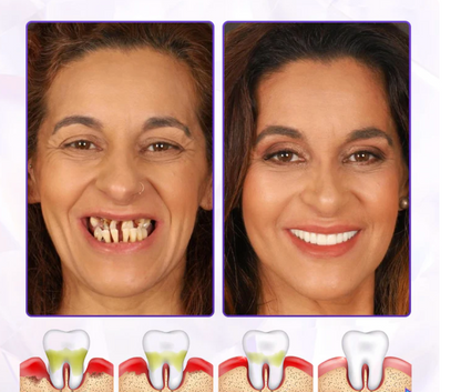 Dentifrice avancé pour la guérison des gencives